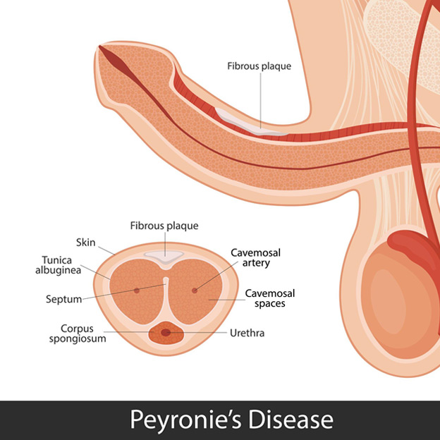Νόσος Περονί (Peyronie) Ή Κάμψη Πέους