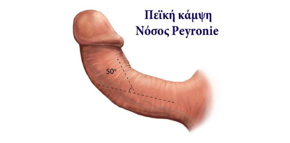 Πεϊκή κάμψη και νόσος Peyronie
